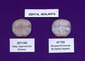 Dental-Sealants-Visual