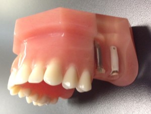 Dental Implant Model